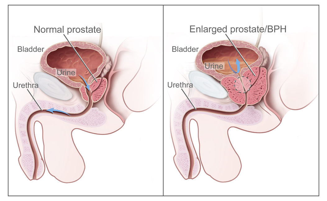 CDR462221 benign prostatic hyperplasia