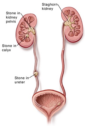 images of kidney stones in urine